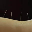 Photo: Acupuncture Relieves Symptoms Of Fibromyalgia, Mayo Clinic Study Finds